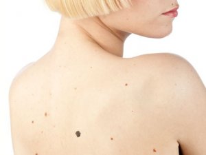 Як уберегтись від раку шкіри