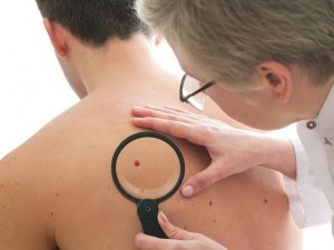 Як не стати жертвою «тихого вбивці»: діагностика та лікування раку шкіри