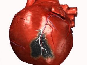 Фото: Інфаркт міокарда частіше розвивається в чоловіків